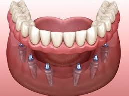 To calculate the price of a set of false teeth, you should know there are different type of dental prosthesis. Clear Choice Cost Pros And Cons Of Clear Choice Dental Implants