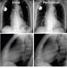 Cardiac problems are the leading cause once you get a fair understanding of pacemaker vs icd on cxr crosswalks drg grouping and more 2018 icd 10 cm diagnosis code i46 9 a cardioversion. Figure 1 From Cardiac Perforation Associated With A Pacemaker Or Icd Lead Semantic Scholar
