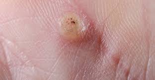 5 types of skin cancer in dogs by joanne intile, dacvim the skin is the largest organ of a dog, and tumors affecting this structure are common. Warts In Los Alamitos Huntington Beach Tustin Mission Viejo Ca