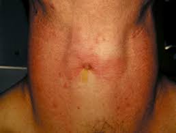 Graves' disease, also known as toxic diffuse goiter, is an autoimmune disease that affects the thyroid. Hyperthyroidism Dermnet Nz