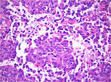 Because atypical teratoid/rhabdoid tumor is fast growing, signs and symptoms may develop quickly and get worse over a period of days or weeks. Atypical Teratoid Rhabdoid Tumor Wikipedia