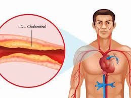 Cholestérol LDL : présentation, taux, conseils pour le réduire...