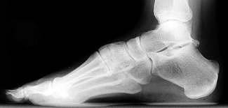 A common cause of bone spurs is osteoarthritis. Bone Spurs Spain Pdf Ppt Case Reports Symptoms Treatment
