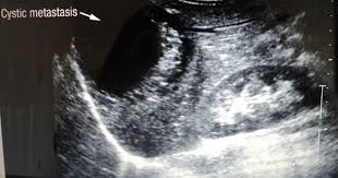 Liver Pathology Ultrasound Images Flashcards Quizlet