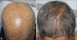 If your diffuse loss is chronic, unresolved, and not associated with a severely stressful event, it could be alopecia diffusa. Overnight Alopecia A Subtype Of Acute Diffuse And Total Alopecia Abstract Europe Pmc