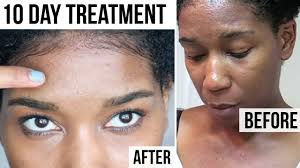 How should this drug be taken? 10 Day Treatment For Tiny Forehead Itchy Chest Acne Bumps Youtube