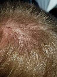 In addition, hair loss can occur in the area of scalp around the bump. Is My Hair Loss Scalp Bumps Oily Skin Chest Back Acne Etc Related Hairlosstalk Forums