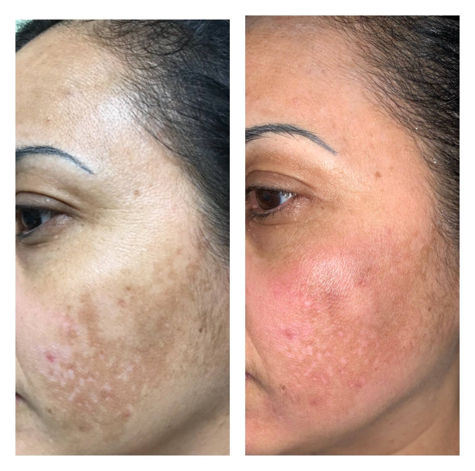 pigmentation treatment product image