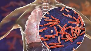 Интервью николоза курдиани с ферузханом якубходжаевым. Tuberkulose Impfstoff Soll Immunsystem Gegen Coronavirus Fit Machen Swr Wissen