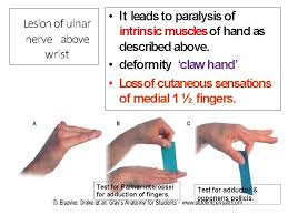 Jull, pt, phd,a shaun p. Ulnar Nerve Anatomy Its Lesions Dr Mukesh Singla