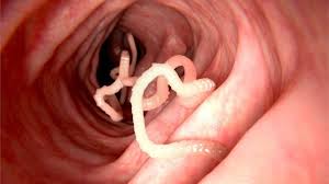 Check spelling or type a new query. North Korean Defector Found To Have Enormous Parasites Bbc News