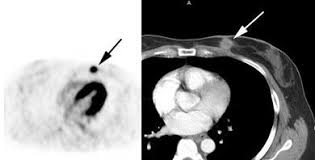Pet scans can also help to assess whether metastatic breast cancer is responding to the treatment. Breast Cancer Cancer Probe