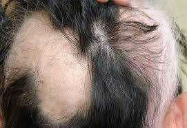 Hair loss treatment treating alopecia areata hair transplant what you can do. Scalp Micropigmentation For Alopecia Microhair Studio South Bay