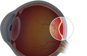 A torn retina usually has the same symptoms as a detached one. Retinal Tears Vs Detachment Kansas City Mo Symptoms And Treatments