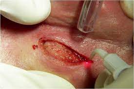Mit Licht Lipome Behandeln Zwp Online Das Nachrichtenportal Fur Die Dentalbranche