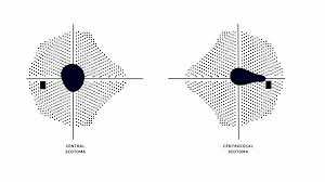 Image result for Visual Field Deficit