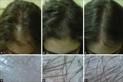 Prp can help accelerate the growth of transplanted hair roots while also thickening existing hair. Prp Archives Hair Loss Cure 2020