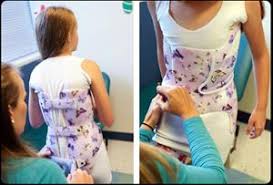 نصائح عملية للأهل لضمان نجاح حزام اعوجاج العمود الفقري