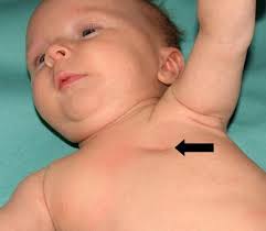 Poland syndrome: from embryological basis to plastic surgery