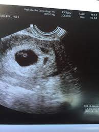 Ultrasound pictures at 6 weeks 1 day. Ultrasound For 6 Weeks Pregnant Novocom Top