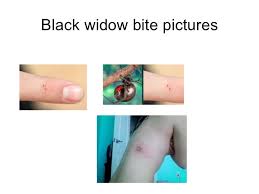 They live throughout the u.s., but most are found in the southern regions. Spider Bites