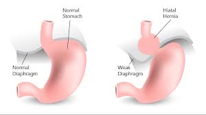 Image result for Hernia Reduction