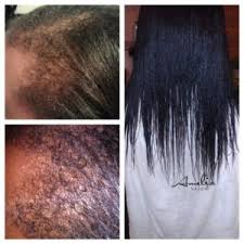 After all, your hair will eventually grow even if you don't use monsitat, it will just take longer to grow your hair to your desired length. Postpartum Alopecia And Hair Loss Amelia Salon
