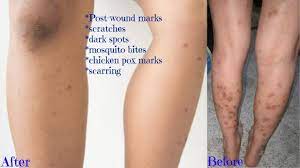 They contain both of cooling and refreshing properties that make them one of the best home remedies. Updated How To Get Rid Of Dark Spots On Legs Body Fast Get Clear Even Skin Tone Youtube