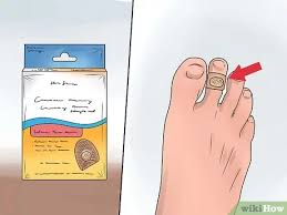 كيفية علاج مسمار اللحم أو الكالو صور توضيحية Wikihow