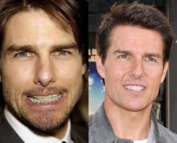 Here's what i've learned since my first cosmetic procedure 25 years ago. Truth Behind The Tom Cruise Face Plastic Surgery Celebrity