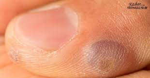 See more ideas about beetlejuice, beetlejuice sandworm, tim burton. 3 Step Home Remedy For Warts Kitchen Stewardship