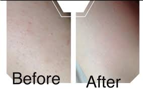 Or the hair grows sideways into the skin due to hardened, dead skin cells on the surface, according to jessica johnson, a completely bare brand ambassador. Pin On Stuff