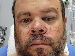 Fundraiser by Gabriel Hatch : Gabe Hatch with medical bills after car crash