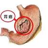  流行病学  消化道肿瘤中占第一位 , 全部恶性肿瘤中占第三位 ( 男性 : Https Encrypted Tbn0 Gstatic Com Images Q Tbn And9gcqqgqwultswd6ltbytia0i Kgziyfxn3szdncwlpsh32v74jnei Usqp Cau