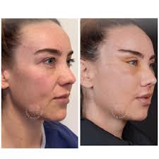 I am in Australia. Trying to research places for a facelift. Some horror  stories from Turkey. Has anyone been to Thailand? Would be good to msg with  someone from Aussie who has