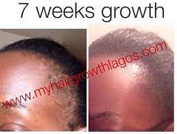 8 Steps To Grow Your Edges Back Within 2 Months Health Nigeria Ways To Grow Hair How To Grow Natural Hair Grow Black Hair