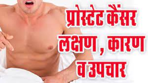 Prostate cancer is a common type of cancer in men, according to the mayo clinic. Prostate Cance Symptoms And Treatment In Hindi à¤ª à¤° à¤¸ à¤Ÿ à¤Ÿ à¤• à¤¸à¤° à¤• à¤²à¤• à¤·à¤£ à¤• à¤°à¤£ à¤‰à¤ªà¤š à¤° Youtube