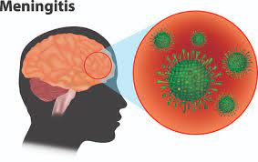 Approximately 80% of all meningitis cases are bacterial, making it the most common type. What Is Meningitis Cloudhospital