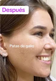 Respuesta a @Edith Clara Calderon La solución realmente efectiva para las  arrugas de la frente , entrecejo y patas de gallo son las inyecciones de  Botox®️