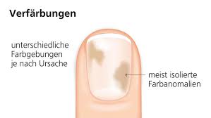 Nagelprobleme Ursachen Tipps Zur Behandlung Sililevo