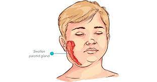 مضاعفات الغدة النكافية انتبه لها ويب طب