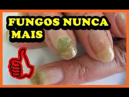 A principal razão é a falta de tratamento do fungo nas unhas na fase inicial. Como Acabar Com Os Fungos Das Unhas Receita Caseira Youtube