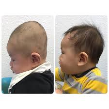 Plagiocephaly no helmet cheap