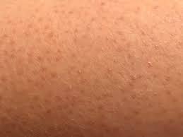 Those who are diabetic may also experience these annoying bumps. Keratosis Pilaris Wikipedia