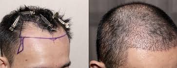 Rachel dished on some of her good hair tips in a new interview with into the gloss. Hair Transplantation Fue Celebrity Secrets