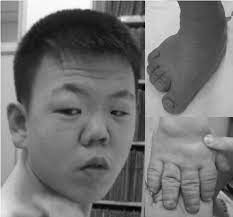 Fetal alcohol syndrome epicanthal folds flat nasal bridge small palpebral fissures upturned nose. Facial Features Including A Broad Depressed Nasal Bridge A Small Download Scientific Diagram