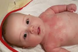 Wie kann ich neurodermitis beim baby erkennen? Baby Hat Vermutlich Neurodermitis Tipps Forum Baby Urbia De