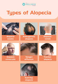 Image result for Alopecia