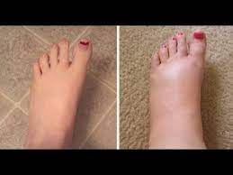 Le plus souvent, cela concerne les pieds, chevilles et jambes, mais peut s'étendre aux bras et mains. Remedes Naturels Pour Les Chevilles Jambes Et Pieds Gonfles Youtube
