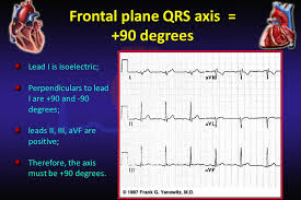Cardiovascular Block Electrocardiogram Ecg Ppt Video Online Download